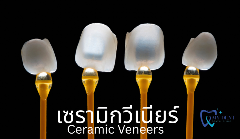 เซรามิกวีเนียร์  
